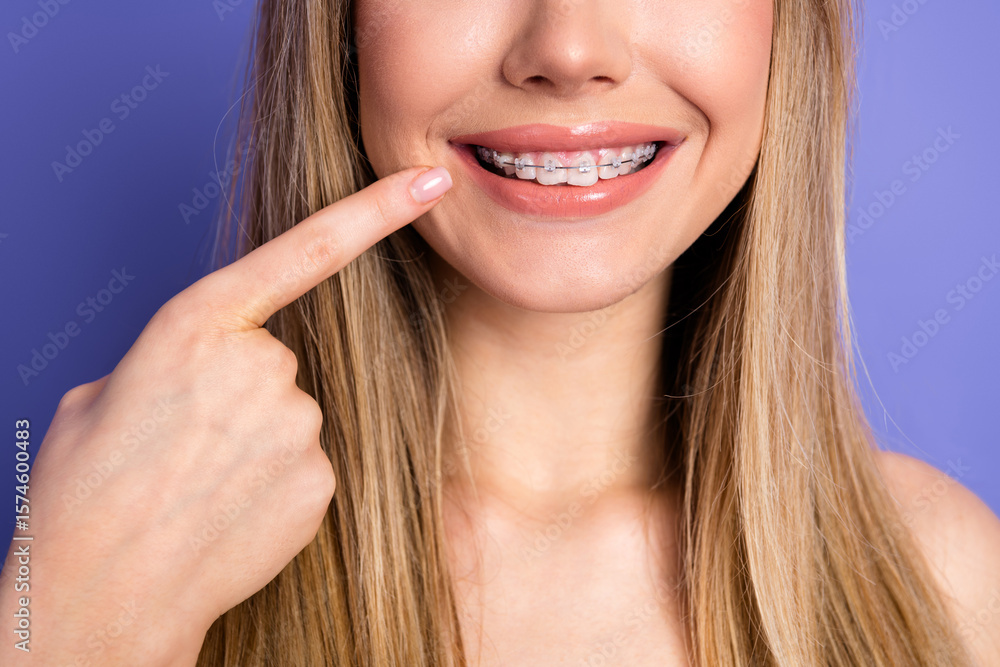 Young woman with braces smiling confidently and pointing, showing dental care on a vibrant purple background Young woman with braces smiling confidently and pointing, showing dental care on a vibrant purple background