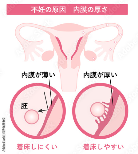 不妊の原因_内膜の厚さ