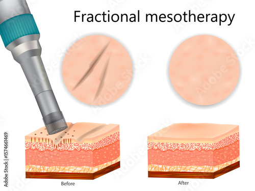Fractional Mesotherapy Procedure: Before and After Skin Treatment. Microneedling Skin Therapy. Dermatological Treatment Diagram