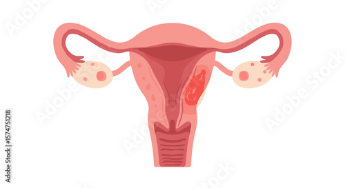Illustration of Damaged Uterus for Awareness on Women's Health Issues and Gynecological Diseases