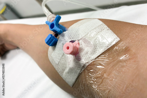Close up view of a patient’s arm with a pink intravenous (IV) cannula and blue three way stopcock valve inserted for hospital treatment, fluid therapy, or medication administration in a clinical setti