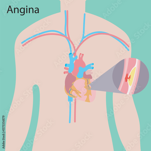 Angina vector illustration showing chest pain, shortness of breath, and sweating. Highlights symptoms to heart attack and acid reflux for quick visual understanding. man 