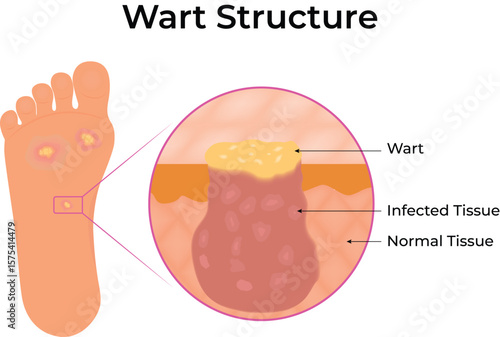 Wart Structure Detailed Diagram of Foot Wart and Tissue Layers