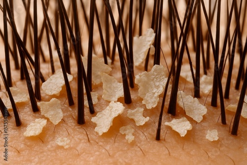 Microscopic view shows dry scalp and dandruff flakes nestled amongst dark hairs, highlighting potential skincare concerns requiring specialized treatment for health.