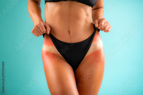 Sunburn manifests on the skin from prolonged UV exposure, evident in redness and tan lines under a bikini