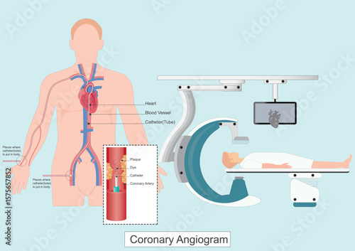 A coronary angiogram CAG is a test that uses X rays to look at the heart