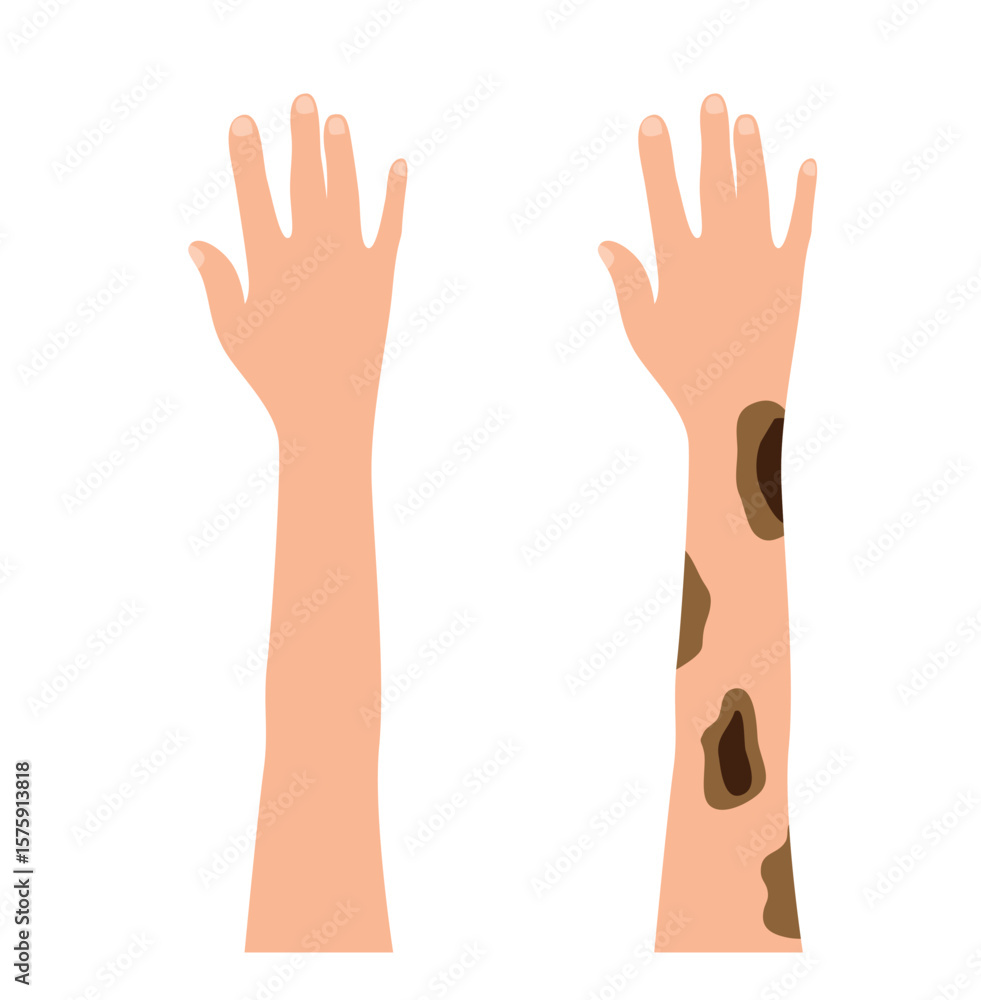 Obraz premium Normal Hand and One with Melanoma Skin Cancer. Disease, health care and medicine vector art