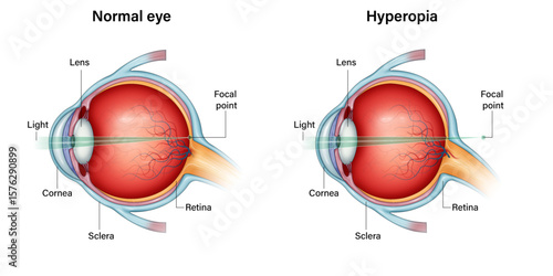 Normal Eye vs Hyperopia (Farsightedness) – Comparative Eye Anatomy Vector