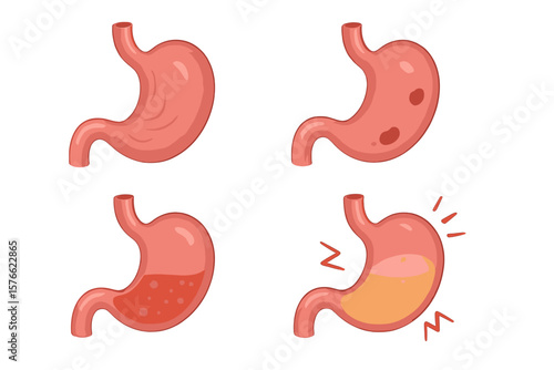 Human stomach vector icon set. Digestive system organ anatomy. Healthy vs unhealthy. Gastritis, ulcer, pain, heartburn, acid reflux disease. Medical digestion illustration concept.