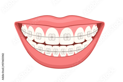 Orthodontic treatment with ceramic braces on teeth. Dental alignment and bite correction process. Healthy white smile with dental brackets. Healthcare and beauty vector.