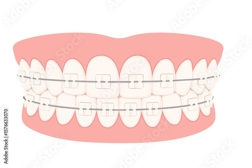 Braces on teeth vector illustration. White clear teeth with ceramic braces. Orthodontic treatment for alignment and bite correction. Dental care and healthy smile concept.