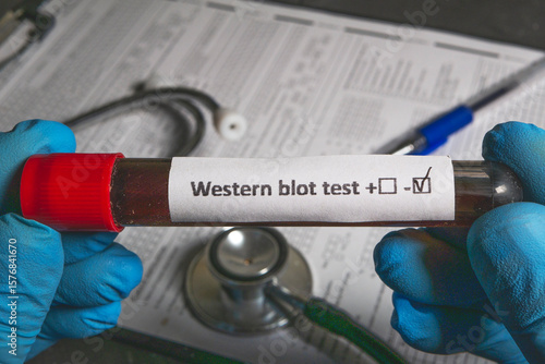 Doctor holding western blot test tube with negative result