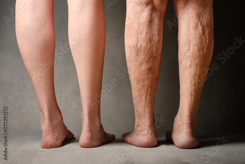 Legs of an elderly and young woman. Comparison of the legs of a young and old woman. Varicose veins on a female legs. Youth and old age. The concept of comparison of youth and old age.