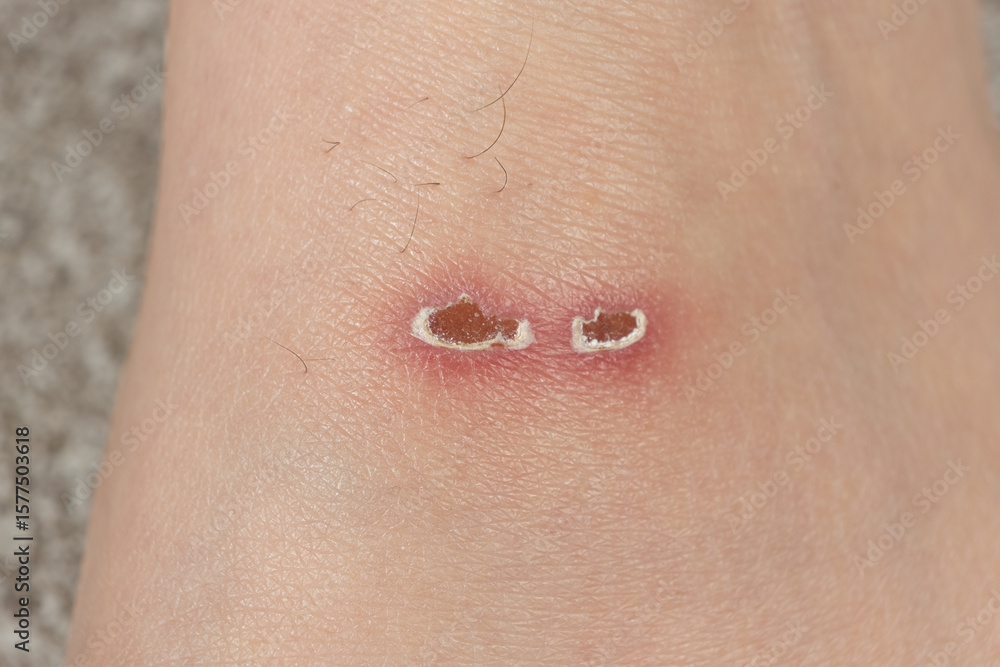 Fototapeta premium Injured Dorsal Side of Feet from Swim Flippers