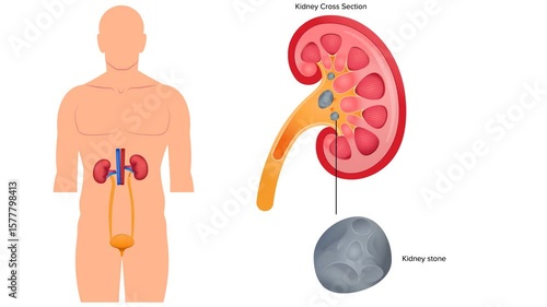 Human kidney Stone Animation, Animation of Kidney stone treatment