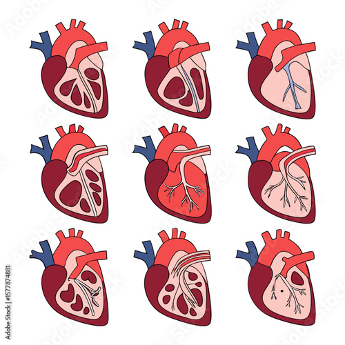 Depiction of the human heart with various congenital defects and anatomical abnormalities, offering a detailed illustration.