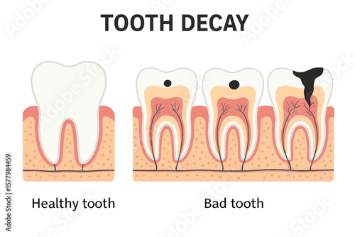 Tooth Decay Stages Vector. Dental Caries Progression. Healthy Tooth vs Bad Tooth Illustration. Oral Health Care Concept. Cavity Development Diagram. Medical Anatomy. Dentist Education. Prevention