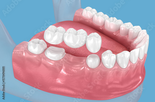 Dental bridge based on 2 teeth. Dental 3D illustration