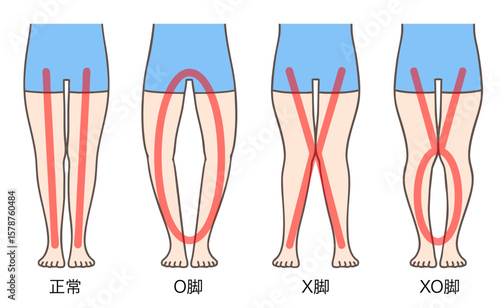 正常な脚、O脚、X脚、XO脚、女性の下肢