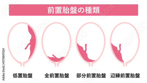 前置胎盤