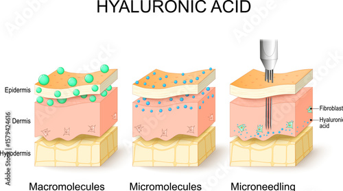 Hyaluronic acid, microneedling, micromolecules, macromolecules