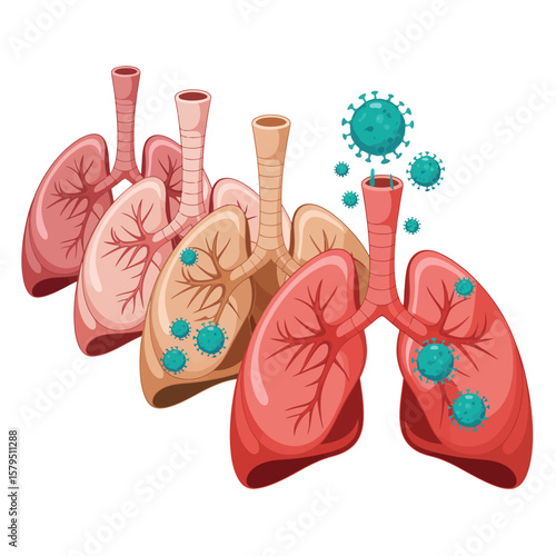 Illustration of human lungs affected by viral infection and disease progression