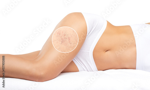 Beautiful slender woman sits on a couch in a spa salon. She shows varicose veins in the lower legs.Treatment of varicose veins and capillaries.