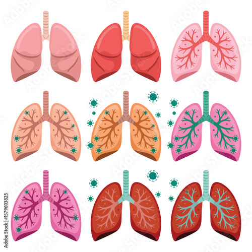 Diagram of Lungs Affected by Various Conditions