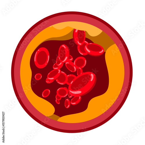 Fatty artery illustration. Atherosclerosis, infarct, ischemia, thrombosis disease. blocked vascular, cholesterol, fatty streak, plaque. vector illustration for medical poster, clinic, education.