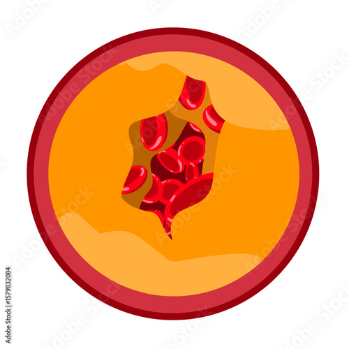Blocked artery illustration. Atherosclerosis, infarct, ischemia, thrombosis disease. blocked vascular, cholesterol, fatty streak, plaque. vector illustration for medical poster, clinic, education.