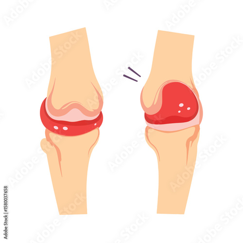 Comparison of healthy and affected joints with rheumatoid arthritis, health awareness