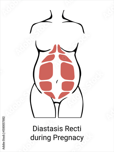 Diastasis in a woman during pregnancy. The anatomy of a Woman. A woman's muscular corset before and after childbirth. Vector illustration
