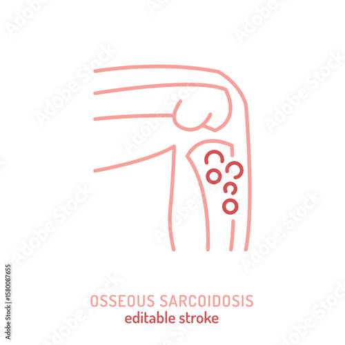 Osseous sarcoidosis icon. Editable vector illustration showing granulomatous inflammation