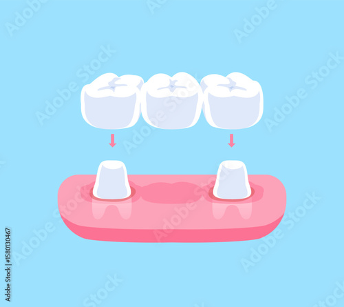 Traditional dental bridges teeth illustration vector design. Dental care concept.