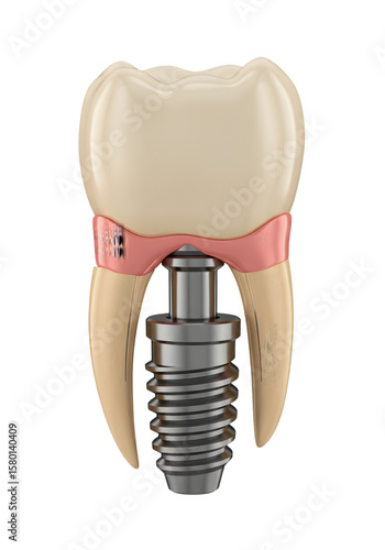 3D Illustration Detailed Dental Implant Screw Prosthesis With Crown Transparent Background