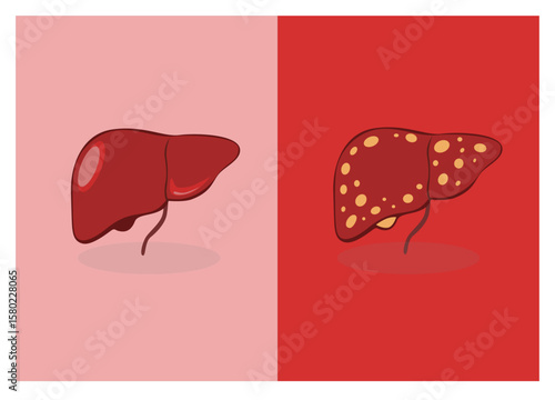 A part of organs: normal liver vs Fatty liver