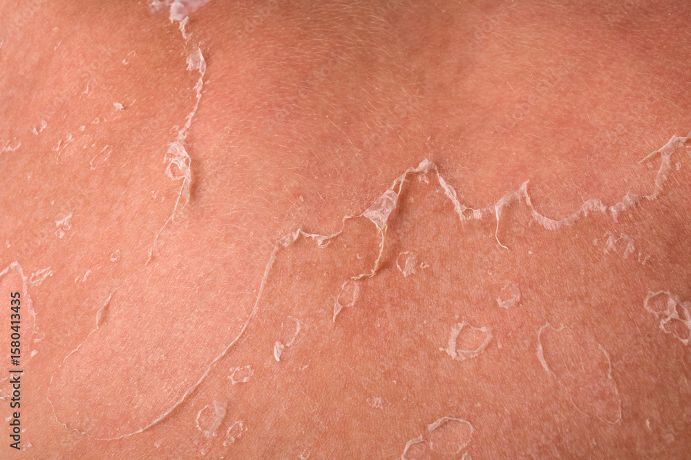 Fototapeta premium Close-Up of Flaky Peeling Skin on Shoulder Due to Sunburn and UV Exposure