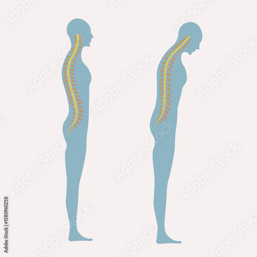 Ankylosing spondylitis vector showing spinal stiffness, pain, fatigue, posture change; includes related conditions like arthritis, sacroiliitis, and spinal degeneration. back silhouette