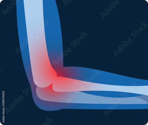 Elbow joint inflammation x-ray vector illustration