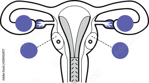 Detailed anatomical depiction of the female reproductive system featuring the uterus and a polycystic ovary rendered with precision and clarity for educational or medical purposes