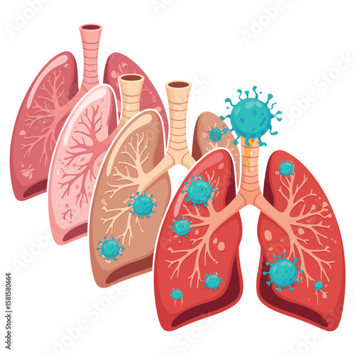 Illustration of human lungs affected by viral infection and disease progression