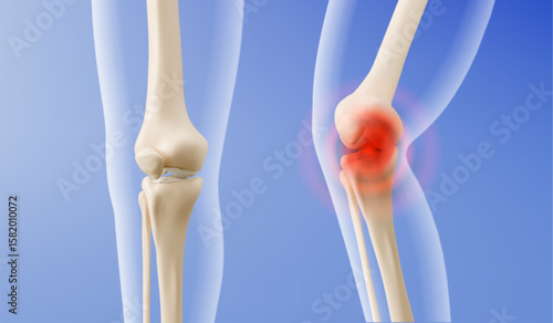 3d medical knee comparison of healthy joint anatomy with bones versus inflamed painful condition. Red glowing area indicates arthritis or injury for orthopedic healthcare education materials.