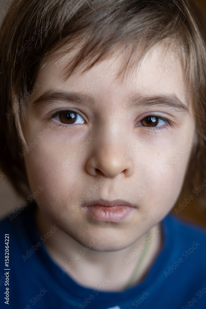 Stye or sty on the boy eye. The eye is swollen. The eyelid is red and inflamed Stye or sty on the boy eye. The eye is swollen. The eyelid is red and inflamed