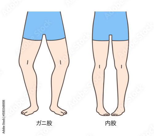 ガニ股と内股の女性、下肢の外旋と内旋