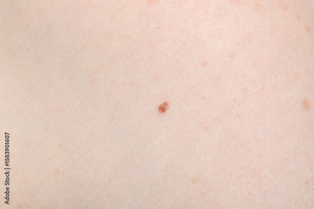 Fototapeta premium Woman with mole on her body, closeup