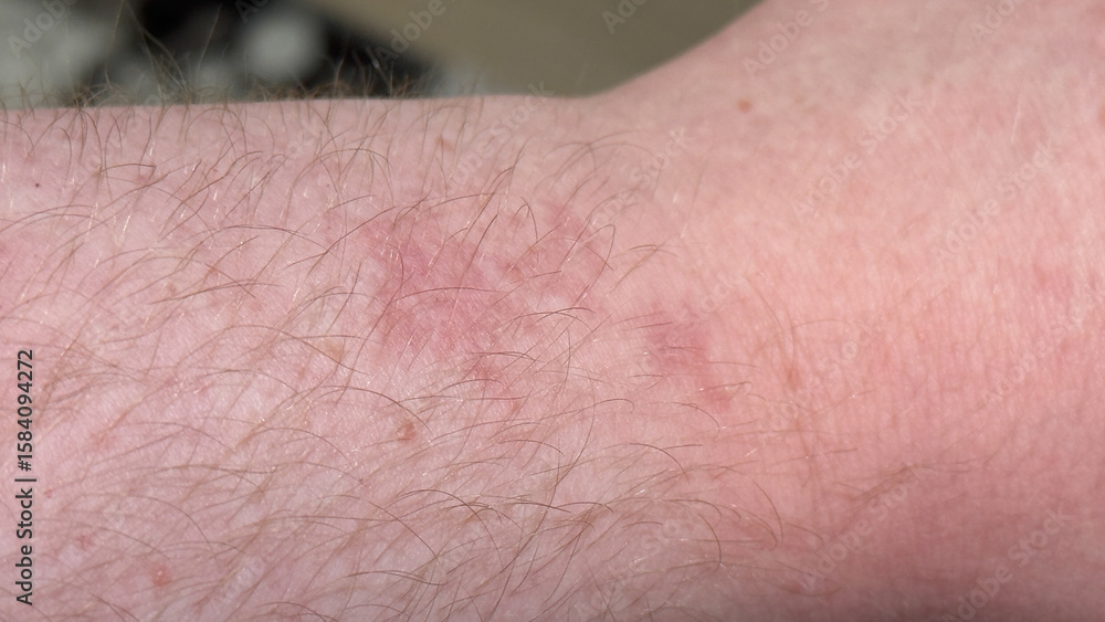 Fototapeta premium Allergic reaction with hives and dermatitis on the forearm of a caucasian man with sensitive skin