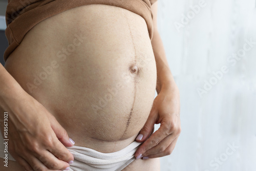 Closeup of woman belly with scar from cesarean section. Care of the suture after the birth of the child.