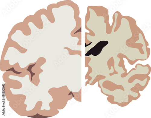 Alzheimer Disease Human Brain Anatomy