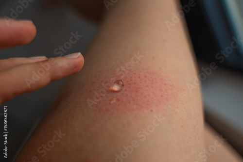 Closeup of woman finger applying clear gel to red swollen skin after wasp sting. Allergic reaction treatment, irritated skin, insect bite care, inflammation relief and dermatological remedy