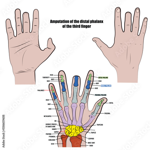 Amputated middle finger, hand X-ray.